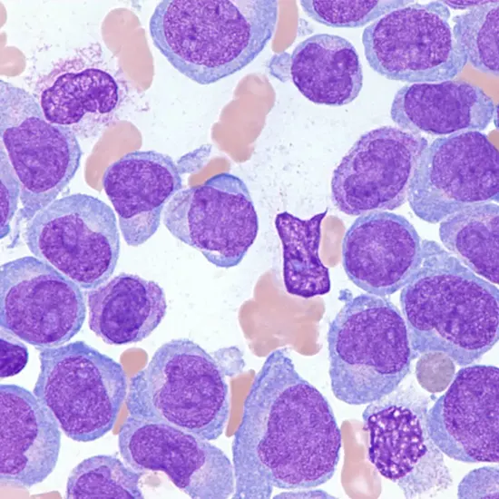 Acute Leukemia -T B or Myeloid